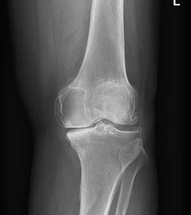 Kellgren and Lawrence system for classification of osteoarthritis ...