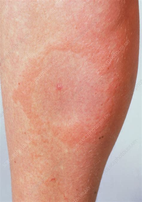 Lyme disease rash - Stock Image - M200/0089 - Science Photo Library