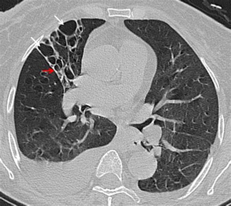 Cystic bronchiectasis in a 35 year-old-man. Axial CT image shows... | Download Scientific Diagram