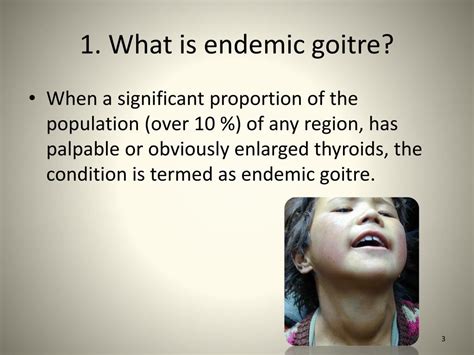 PPT - Endemic goiter in S ri L anka PowerPoint Presentation, free download - ID:2207796