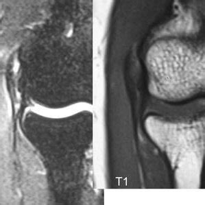 Magnetic resonance imaging (MRI) showing lateral epicondylitis in a ...