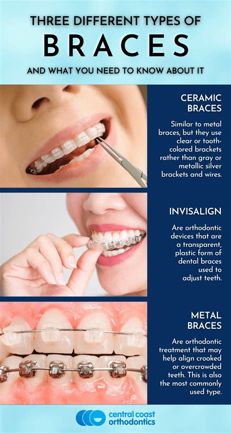 Braces: Types How They Work, 50% OFF | www.pinnaxis.com