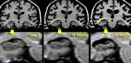 The Radiology Assistant : Brain - Dementia: Role of MRI