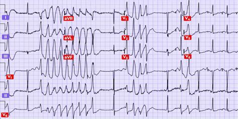 Difference Between Polymorphic and Monomorphic Ventricular Tachycardia