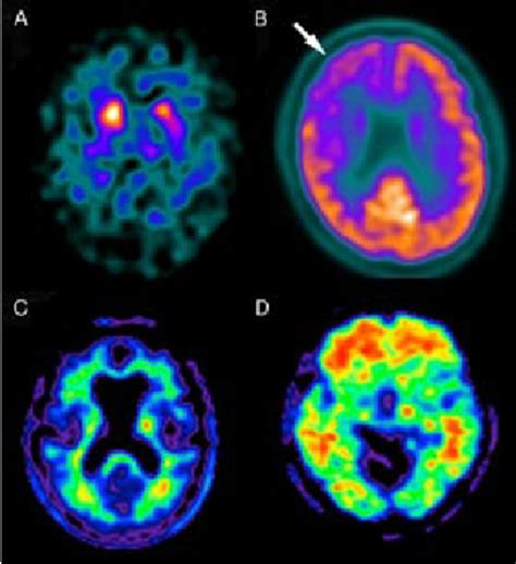 | (A) Dopamine transporter imaging shows symmetrical reduced basal... | Download Scientific Diagram