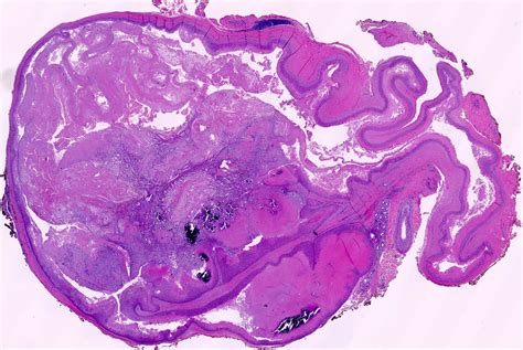 Proliferating Pilar Cyst