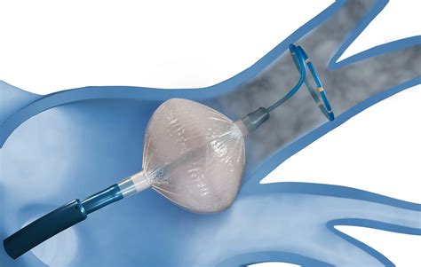 Cryoablation Devices vs. Radiofrequency Ablation: Which is Better for Treating Liver Cancer ...