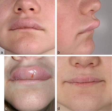 Cheilitis granulomatosa. Initial presentation (a, b). Marked increase ...