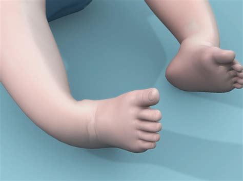 Video - Clubfoot (Talipes Equinovarus) - HealthClips Online