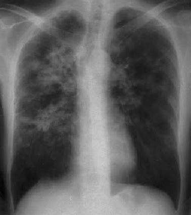 Chest X-ray showing bilateral patchy infiltrates affecting the upper... | Download Scientific ...