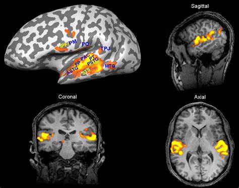 Auditory Cortex Mri