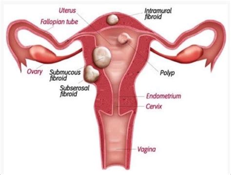 Uterine Fibroid - Homeo Clinic Chennai - Best Homeopathy Doctor in Chennai