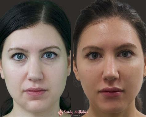 Botox Masseter Jaw Reduction - Benefits, Costs & Results