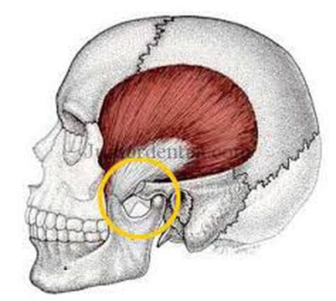 Tmj ankylosis - MEDizzy