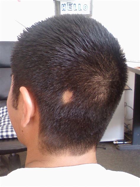 File:Alopecia areata bald spot.jpg - Wikimedia Commons