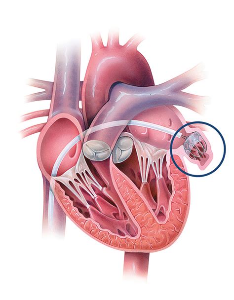 Left Atrial Appendage Closure Procedures | Johns Hopkins Medicine