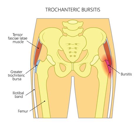 Trochanteric Bursitis Pain Pattern