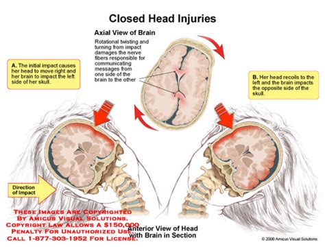 Closed Head Injuries