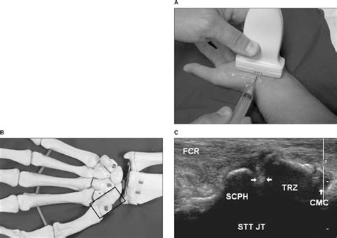 Accuracy of Sonographically Guided and Palpation Guided ...