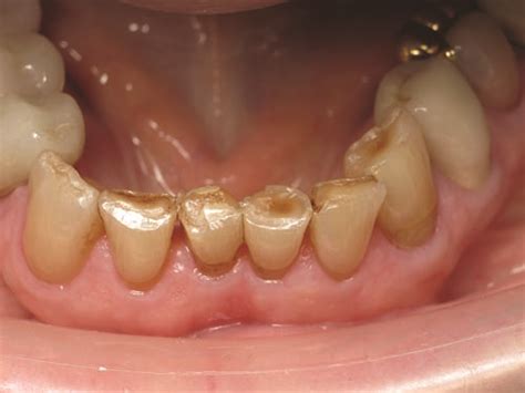 Show Your Work: Treating Incisal Edge Wear by Dr. Marvin Fier - Dentaltown