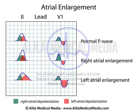 Alila Medical Media | Atrial enlargement ECG | Medical illustration