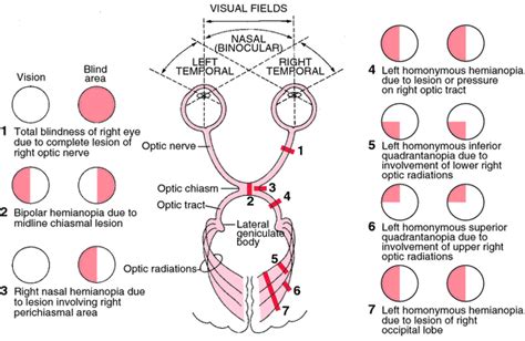 How visual fields are affected by lesions of visual pathway. : r/Medpedia