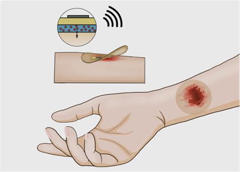 Revolutionizing Wound Healing: Stanford Researchers Develop Smart ...