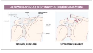 Separated Shoulder vs. Dislocated Shoulder | AOS