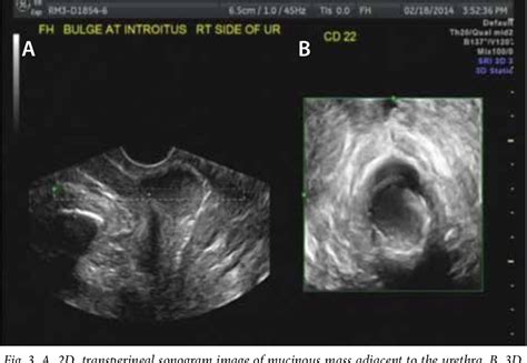 [PDF] Skene's gland duct cysts: The utility of vaginal/transperineal imaging in diagnosis and ...