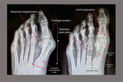 The syndesmosis bunionectomy — Bellevue Podiatric Physicians