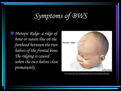 PPT - p57: Beckwith-Wiedemann Syndrome PowerPoint Presentation, free download - ID:5332115