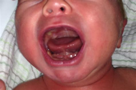 Tongue Tie (Ankyloglossia) - Infant & Newborn - Causes, Treatment