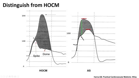 Hemodynamic assessment of aortic stenosis: technical tips- Elias Hanna, Univ of Iowa - YouTube