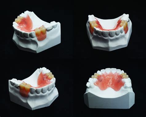 Prosthodontics | GlobeHealer