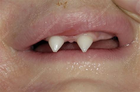 Abnormal teeth in ectodermal dysplasia - Stock Image - C004/2440 ...