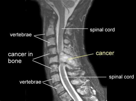 Spinal Cancer Mri - CancerWalls