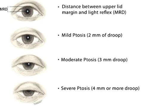 Sagging Eye Syndrome: Causes, Symptoms, Diagnosis & Treatment - Daily ...