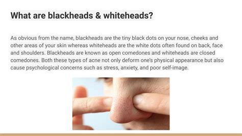 PPT - Blackheads & Whiteheads – Causes, Prevention & Treatment Tips ...