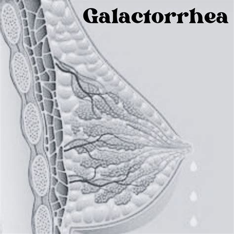 Galactorrhea: Causes, Symptoms, And Treatment