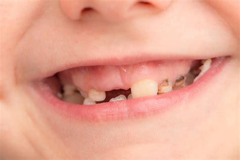 Child tooth decay crisis discussed by MPs and Ministers - Dentistry.co.uk