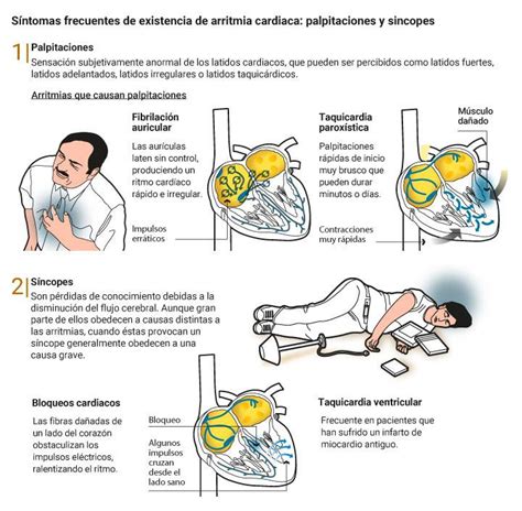 Sintomas De Arritmia Cardiaca