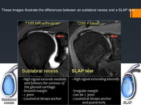 Shoulder labral tears MRI