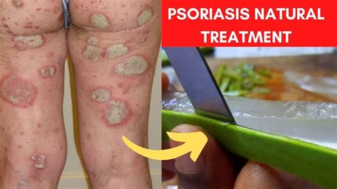 Home Remedies For Psoriasis (3 Proven Natural Treatments) - YouTube