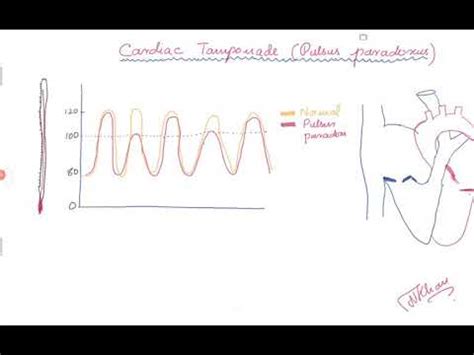 Cardiac Tamponade and Pulsus paradoxus - YouTube