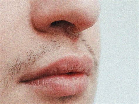 Cold sore under nose: Symptoms, causes, treatments, and more