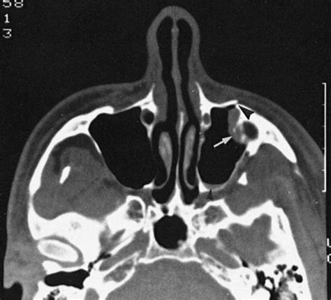 Facial Trauma | Radiology Key