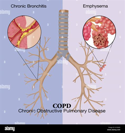 Illustration of chronic obstructive pulmonary disease (COPD), a common lung disease where ...