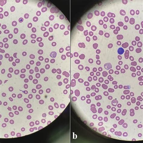 (a) Peripheral blood smear shows the presence of schistocytes, helmet ...