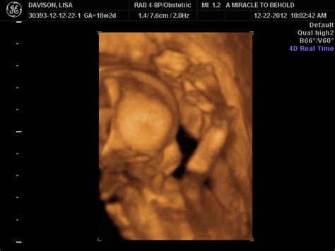 Pickles 'n Pink: 3D Ultrasound - 18 Weeks