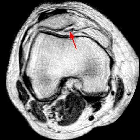 Synovial Plicae of the Knee - Radsource